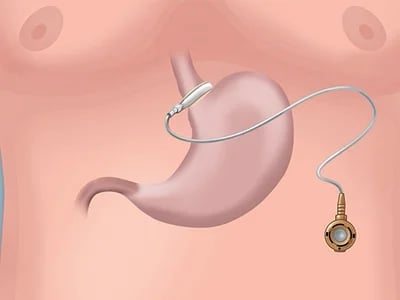 Warum Patienten Dr. Volkan Arayıcı und seine Magenverkleinerung Türkei Beste klinik wählen